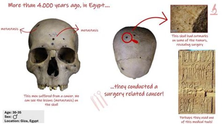 Ancient Egyptian Skull With Brain Cancer Shows Signs Of Surgery